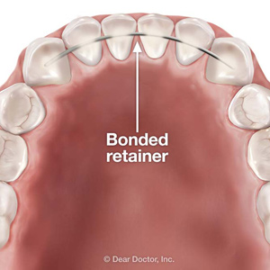 root resorption in deciduous teeth after applying orthodontic forces