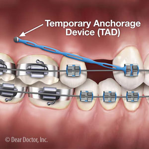 Anchorage Tools Help Orthodontists Correct Complex Bite Problems Anchorage Tools Help Orthodontists Correct Complex Bite Problems