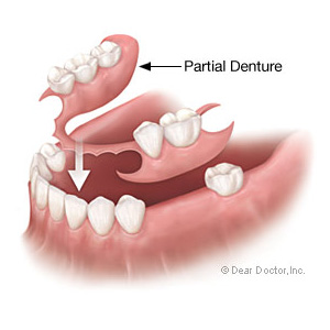 PartialDenturesanAffordableAlternativetoMoreExpensiveRestorations