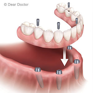ImplantsCanProvideEffectiveOptionsforTotalToothReplacement