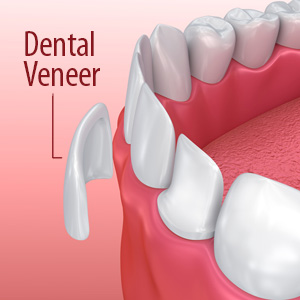 PorcelainVeneersALessInvasiveWaytoTransformYourSmile