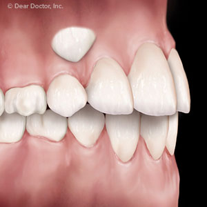 Coaxing Impacted Teeth to the Right Position can Improve Your Smile Coaxing Impacted Teeth to the Right Position can Improve Your Smile