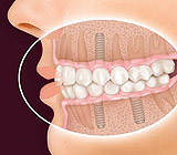 ConsideringBoneandGumsCriticaltoAchievingaBetterSmileWithImplants