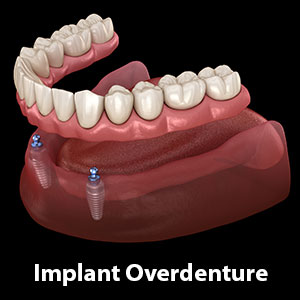 Implants Make Dentures More Secure, Comfortable and Bone-Friendly