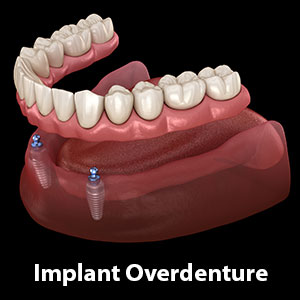Implants Make Dentures More Secure, Comfortable and Bone-Friendly Implants Make Dentures More Secure, Comfortable and Bone-Friendly