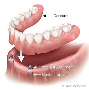 Implant-SupportedDenturesProvideBetterFitandmayStopBoneLoss