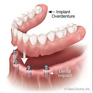 Implant-basedOverdenturesmaybeaBetterLong-TermFitOption