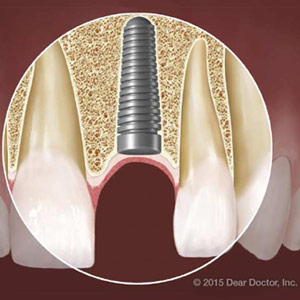 DentalImplantsandDiabetes