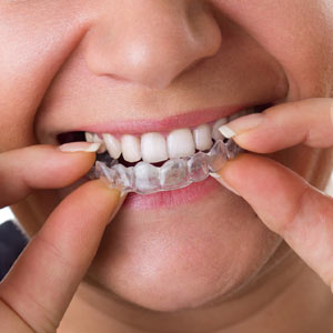 An Orthodontic Retainer: Insurance Well Spent for Keeping Your New Smile An Orthodontic Retainer: Insurance Well Spent for Keeping Your New Smile
