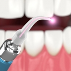 ThisLaserProcedurePromisesBigBenefitsforGumDiseaseTreatment