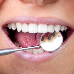 LingualBracesAnInvisibleWaytoMoveYourTeeth