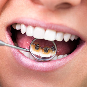 LingualBracesAThirdChoiceforMovingTeeth