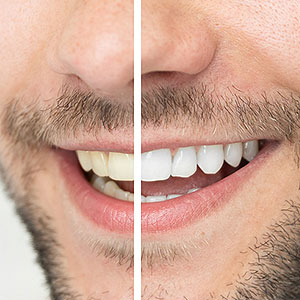 ExperienceAgaintheSmileofYourYouthThroughTeethWhitening