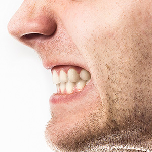 effects of nighttime teeth grinding