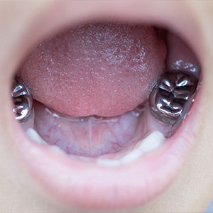 metal caps children's teeth