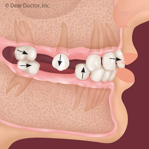 ThoughnotAlwaysSeenitsStillImportanttoReplaceaMissingBackTooth