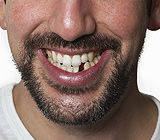 ReplaceMissingTeethtoPreventOtherTeethFromMovingOutofPlace