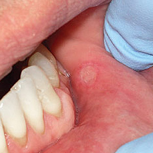 do wisdom teeth cause mouth ulcers