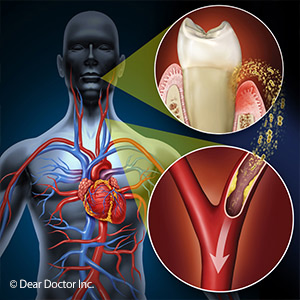 GumDiseaseCouldImpactMoreThanYourOralHealth