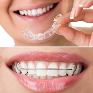 ARetainerHelpsyouKeepYourNewSmileaftertheBracesComeOff