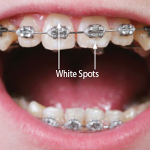 what makes white spots on teeth