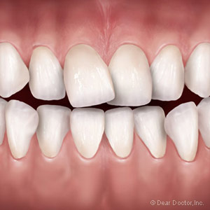 3OrthodonticOptionsforCorrectingBadBites