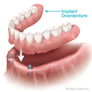overdenture.
