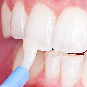 Give Your Child Added Protection Against Cavities With Topical Fluoride Give Your Child Added Protection Against Cavities With Topical Fluoride