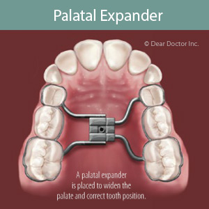 expanders for the teeth