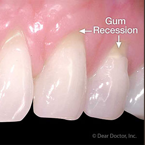 GumRecessionCanHarmYourOralHealthandYourSmile