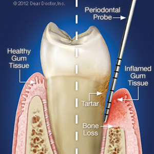Periodontal Probing Increases Accuracy in Diagnosing Gum Disease Periodontal Probing Increases Accuracy in Diagnosing Gum Disease