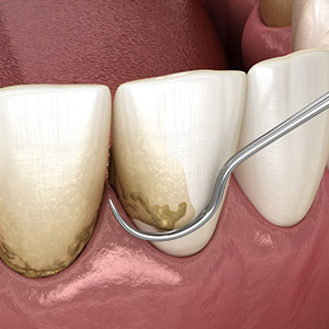 YourGumsNeedExtraCareAfterPeriodontalDisease