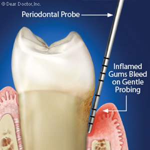 PeriodontalProbingCanTellUsaLotAbouttheSeverityofaGumInfection
