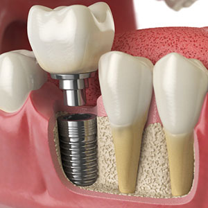 4ReasonsDentalImplantsAreaWiseChoiceforToothReplacement