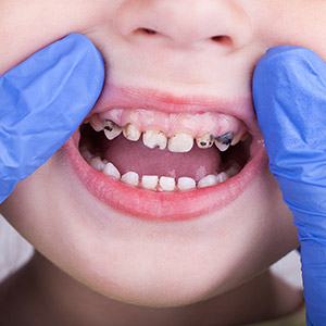 SavingPrimaryTeethFromDecayIsTotallyWorthIt-HeresHow