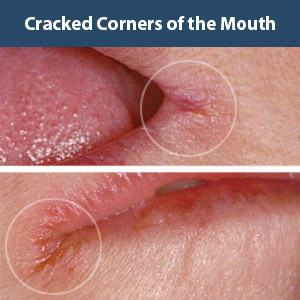 CrackedMouthCornersHowtoResolveThisIrritatingProblem