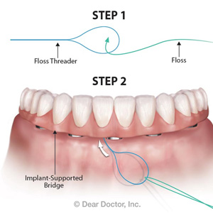 WhyYouShouldFlossAroundtheImplantsSupportingYourBridge