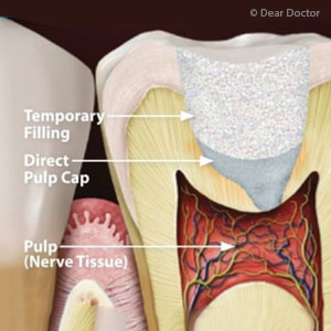 YouMightAvoidaRootCanalwithThisTooth-SavingProcedure
