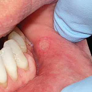 YouMayNeedYourDentistsHelpEasingthePainofSevereCankerSores