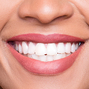 Transform ‘Smile Zone’ Teeth With Composite Resins Transform ‘Smile Zone’ Teeth With Composite Resins