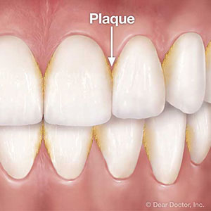 tartar build up back teeth