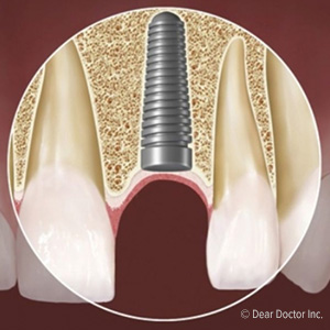 DiabetesDoesntHavetoStopYouFromAcquiringDentalImplants