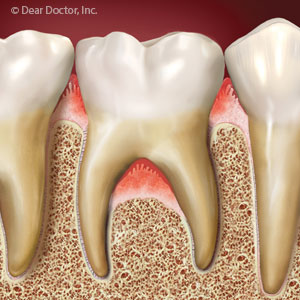 GumInfectionAroundToothRootsCallsforImmediateAction