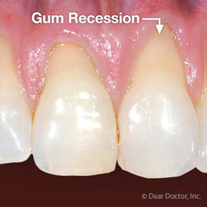 gums receding canine teeth