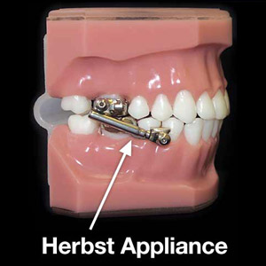 ThisOrthodonticDeviceCouldReducetheNeedforFutureBraces