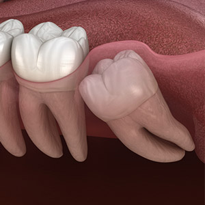 WisdomTeethBearCloseMonitoringforFutureDentalHealth