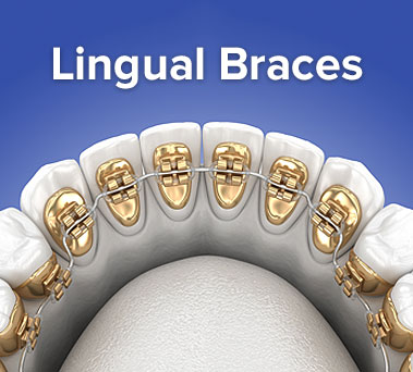 New “Behind the Teeth” Braces Could Give You the Advantage of “Invisibility” New “Behind the Teeth” Braces Could Give You the Advantage of “Invisibility”
