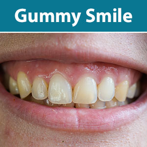 ThereAreaSeveralPossibleCausesforaGummySmile