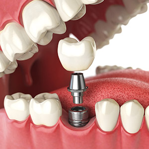 ImplantsCouldHelpYouKeepRemainingTeethLonger