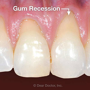 4 Common Causes for Gum Recession